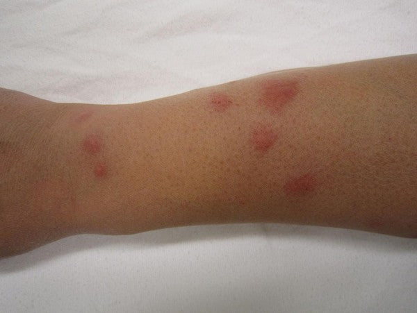 Why Are Bed Bug Bites So Annoying?