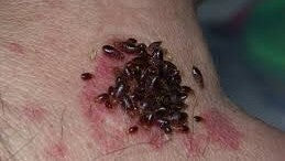 Bed Bug Bites And Your Mental Health