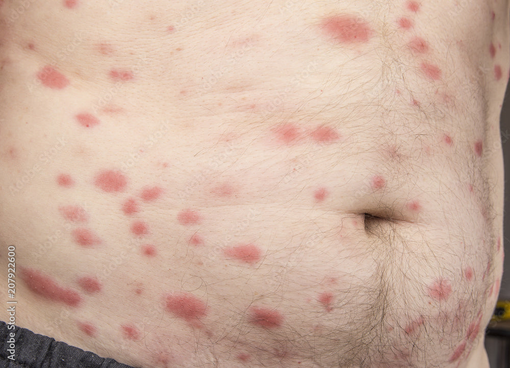A photograph showing multiple bed bug bites on a person's stomach area, characterized by red welts and skin irritation